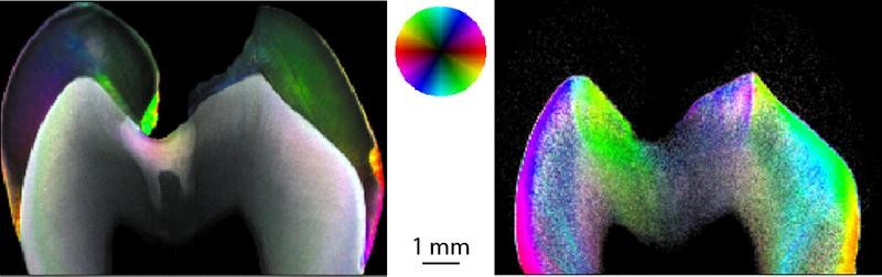Dichte und Orientierung von 60 bis 70 nm grossen Nanostrukturen: Das Farbrad zeigt die Orientierung des Streusignals, die Farbsättigung den Orientierungsgrad und die Farbintensität die Streudichte. Während man die kariöse Schädigung der keramischen Komponenten links) im Zentrum der Zahnscheibe deutlich erkennen kann, ist diese im Kollagen (rechts) unsichtbar.
Foto: Biomaterials Science Center der Universität Basel