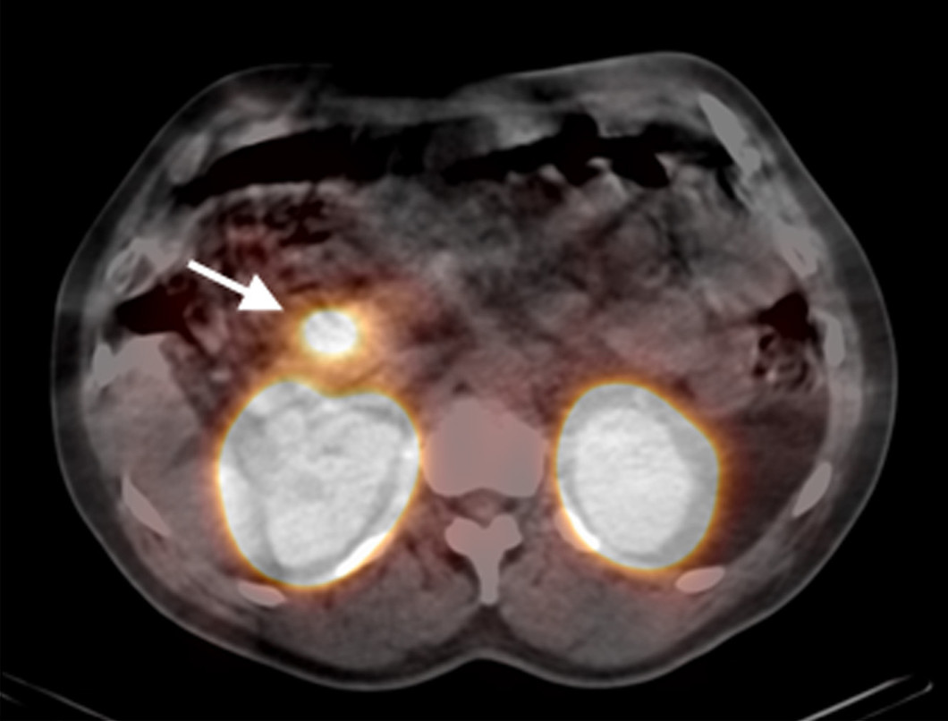 The arrow points to the accumulation of the low-level radioactive substance in the insulinoma. In this case, the insulinoma was localized in the head of the pancreas. As the substance is released through the kidneys, the kidneys are visible as well. (Picture: Nuklearmedizin, Universitätsklinikum Freiburg i. Br.)