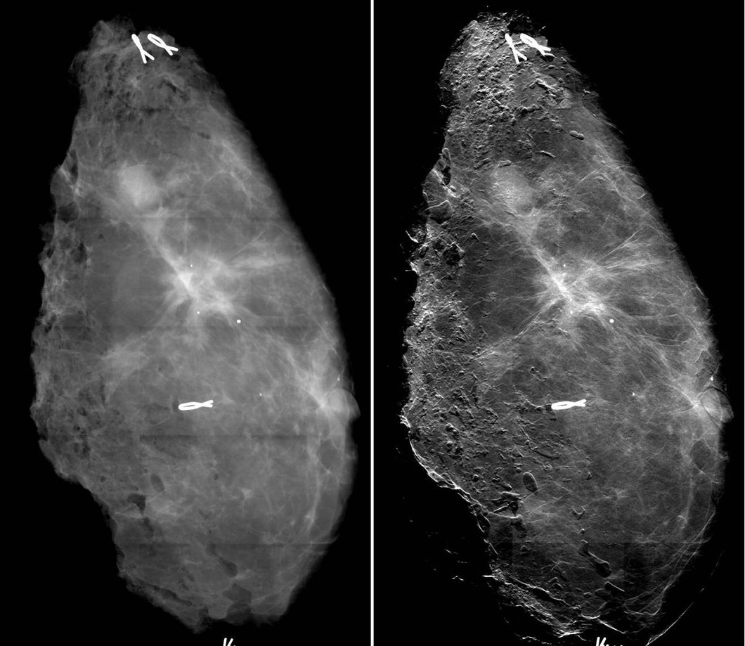 Der Vergleich von Röntgenaufnahmen von Brustgewebe mit einer konventionellen Mammografie sowie der neuen Mammografiemethode zeigt eine deutliche Verbesserung der Bildschärfe und damit der Sichtbarkeit der Ausläufer des Tumors (hell). Bild: Paul Scherrer Institut/Kantonsspital Baden