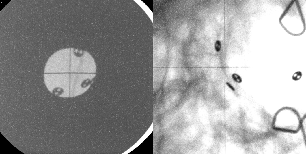 Before every treatment session in OPTIS, two X-ray images are taken on which black, button-like dots can be seen. These are tiny metal plates that are attached to the eye from the back. They help to position the patient’s eye, and thereby the tumour, in exactly the same way for each irradiation. The large grey circle on the image to the left is the aperture plate. It shapes the proton beam, causing it to strike only the light-grey area. (Photo: Paul Scherrer Institute)