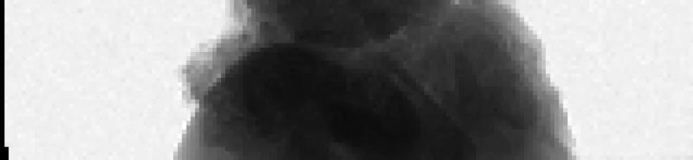 kidney stone: low resolution analog image (no interpolation)