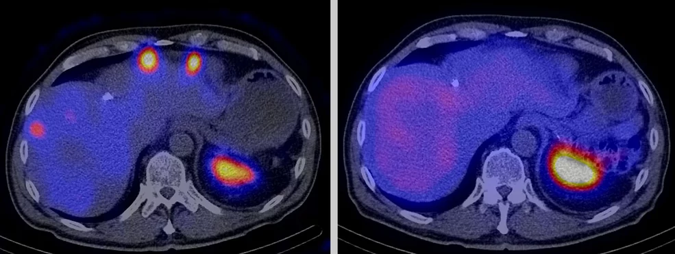 Radioactive drugs also destroy a tumour’s scattered metastases. The two photographs show a cross-section of a patient’s stomach, whose cancer has formed metastases in the liver. The image on the left was taken directly after the first treatment with a radioactive drug. The white, yellow and red circles at the top depict the metastases. The image on the right was taken after the third treatment five months later: no tumour metastases are visible any longer. The large colour circle at the bottom right in the…
