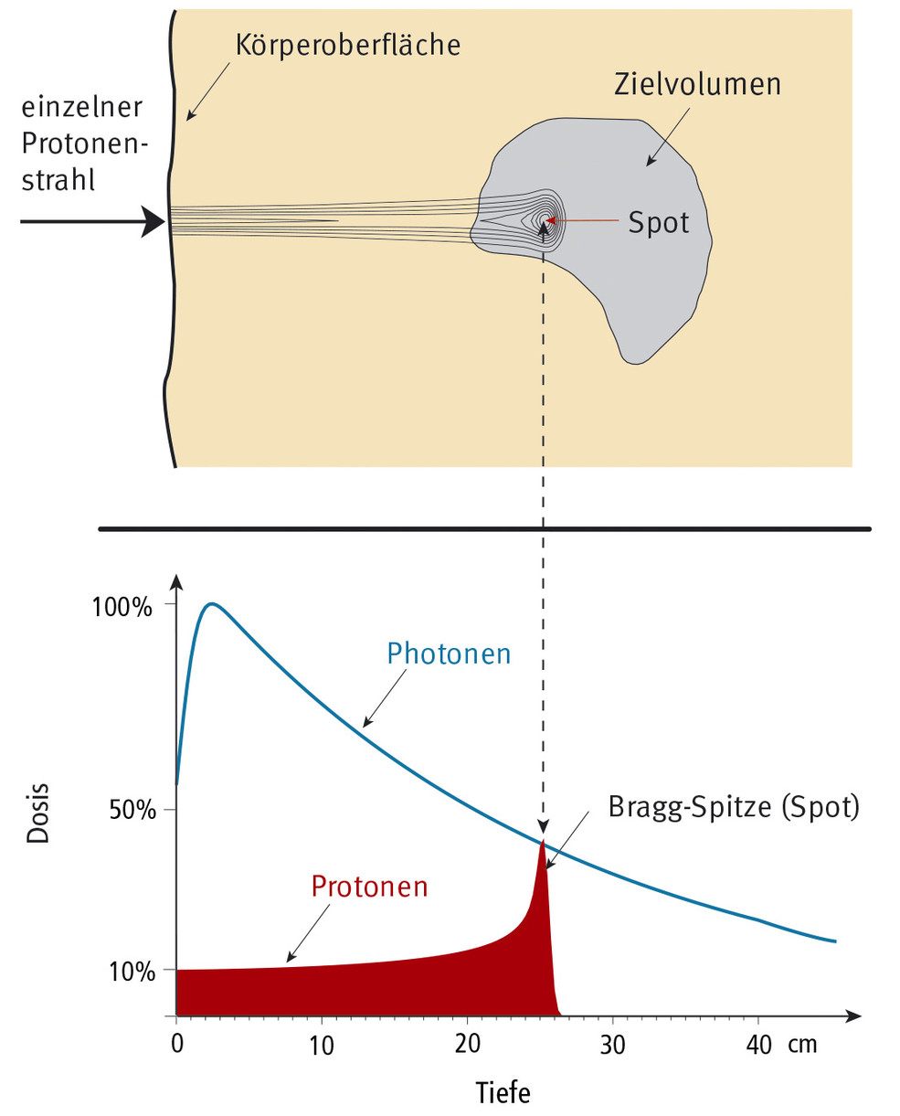 Strahlendosis eines Protonen-Bleistiftstrahls entlang der Eindringtiefe in den Körper. Die Reichweite dieser Protonen ist 25 cm. Oben die als Höhenlinien dargestellte Dosisverteilung, unten die Dosiswerte längs der Tiefe, im Vergleich mit einem Photonen-Dosis­verlauf.