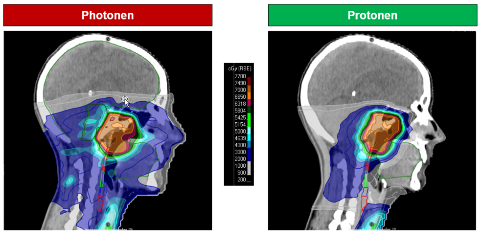 Planvergleich für einen Patienten mit einem Nasenraum-Karzinom. Man erkennt, dass die Bestrahlungsdosis im Bereich des Mundes und der Schluckstrasse im Protonenplan (rechts) deutlich verringert ist.