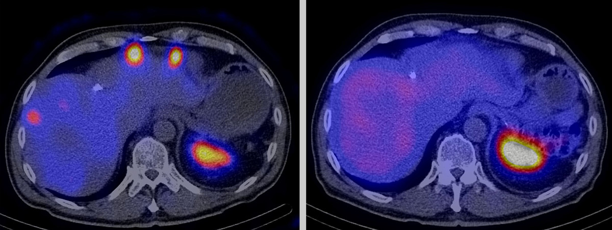 Radioactive drugs also destroy a tumour’s scattered metastases. The two photographs show a cross-section of a patient’s stomach, whose cancer has formed metastases in the liver. The image on the left was taken directly after the first treatment with a radioactive drug. The white, yellow and red circles at the top depict the metastases. The image on the right was taken after the third treatment five months later: no tumour metastases are visible any longer. The large colour circle at the bottom right in the…