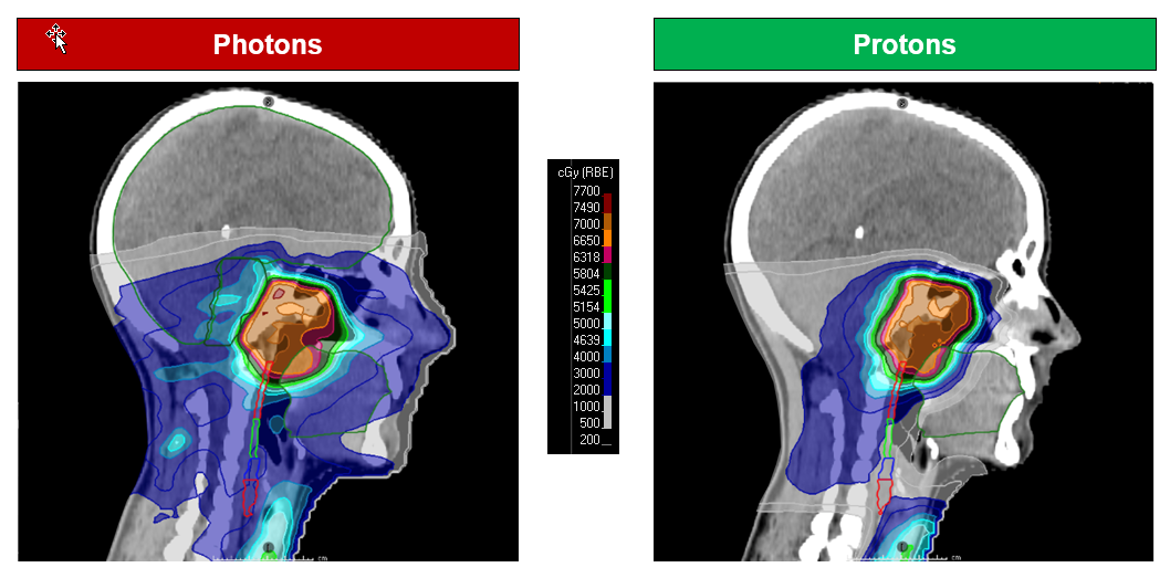 Plan comparison for a patient with a nasal carcinoma. This shows that the radiation dose in the mouth area, pharynx and hypopharynx is clearly reduced in the proton plan (right).