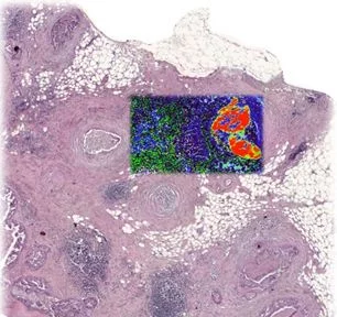 Breast cancer lesion