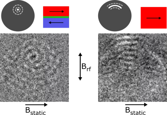 Focusing of spinwaves from a deformed vortex core
