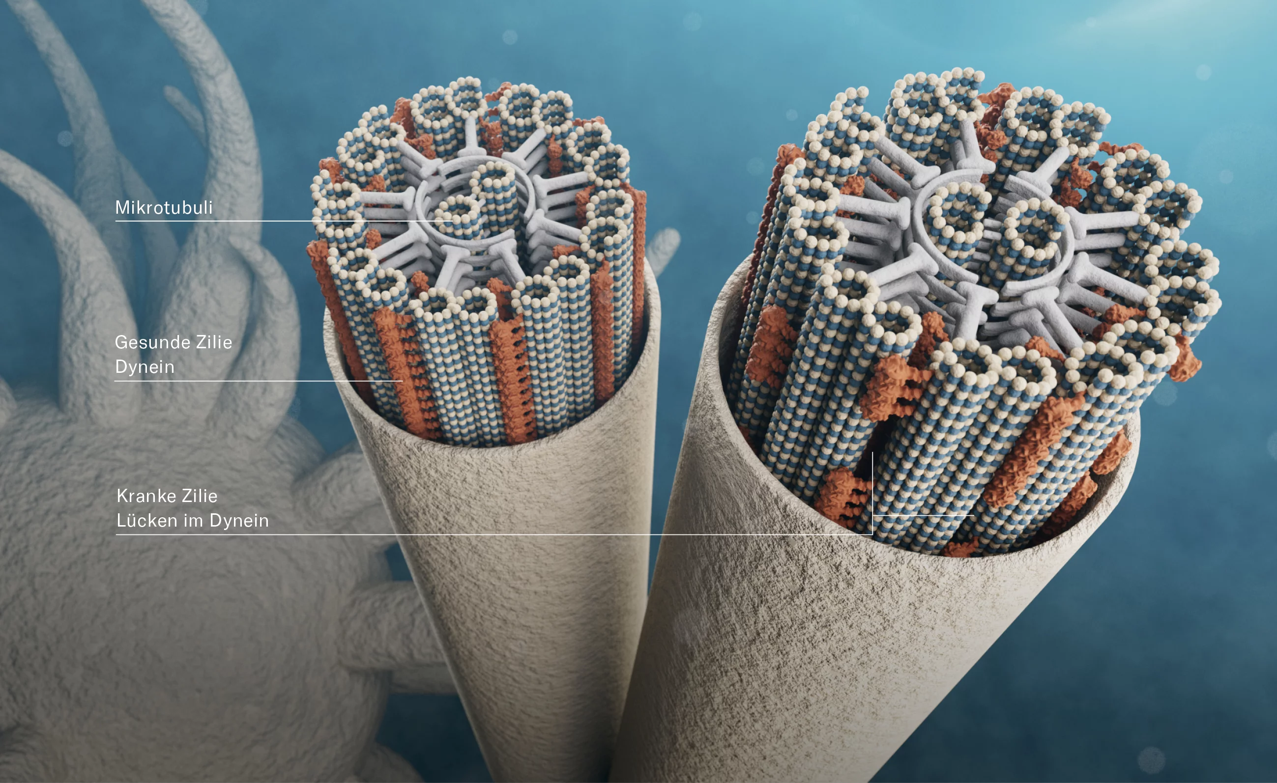 Genetische Defekte können dazu führen, dass die Mikrotubuli der Zilien nicht wie sonst durchgängig mit Motorproteinen, sogenanntem Dynein (rot), besetzt sind. Solche Lücken – wie bei der Zilie rechts erkennbar – sind Ursache der primären Ziliendyskinesie, einer multiplen Erkrankung unter anderem der Atemwege, bei der die Bewegung der Zilien eingeschränkt ist. Früh erkannt, kann ihr Fortschreiten verlangsamt werden.