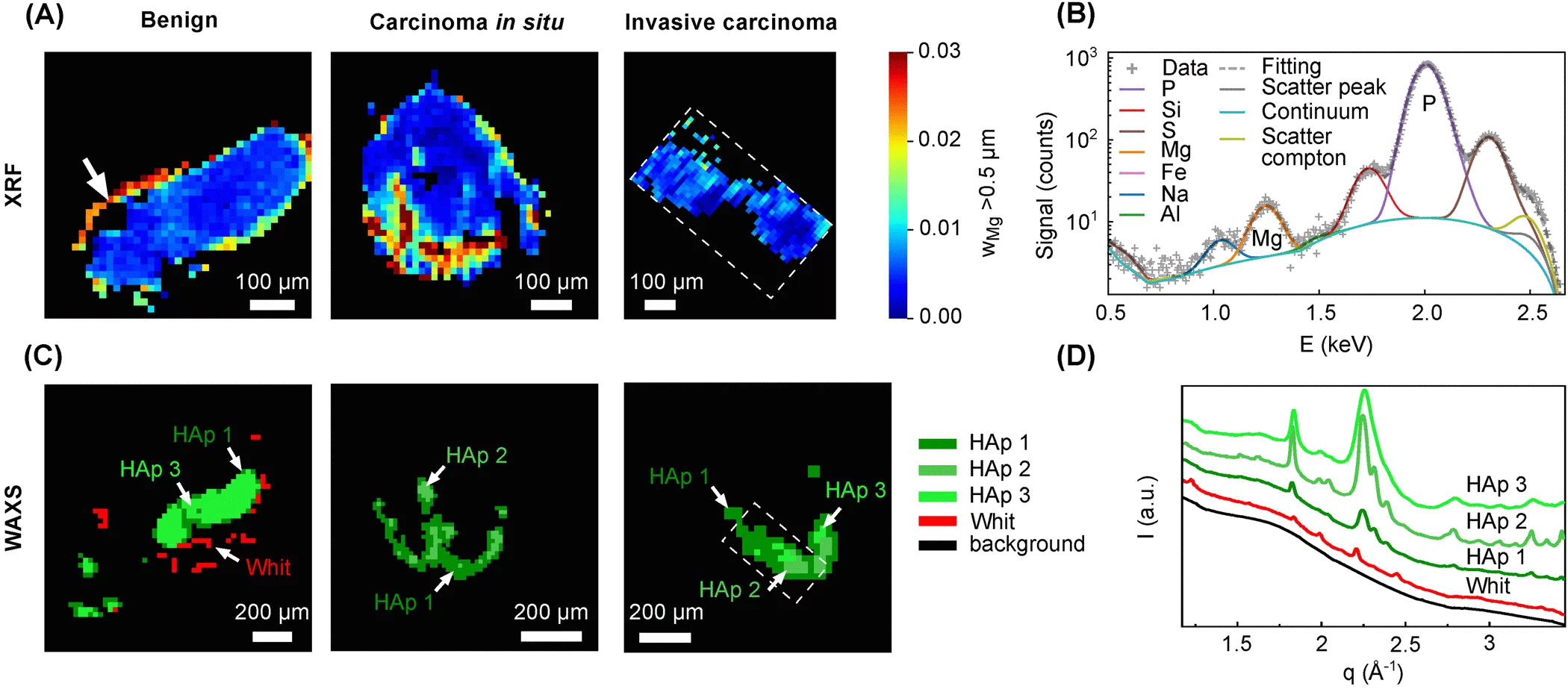 Whitlockite as a potential marker in breast microcalcifications