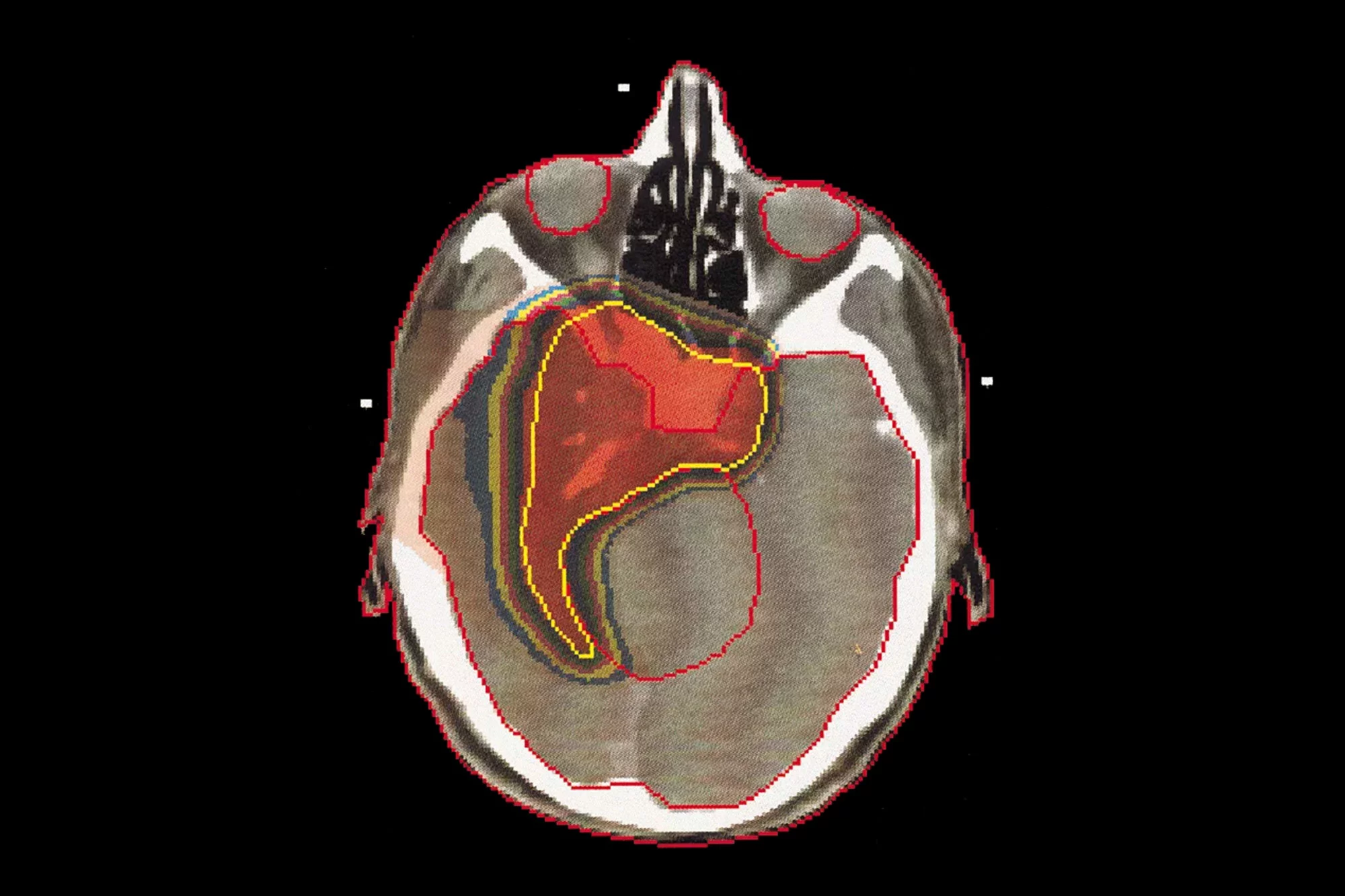 An example of a treatment plan delivered to a brain tumour showing the extent of the precision of the spot-scanning technique.
