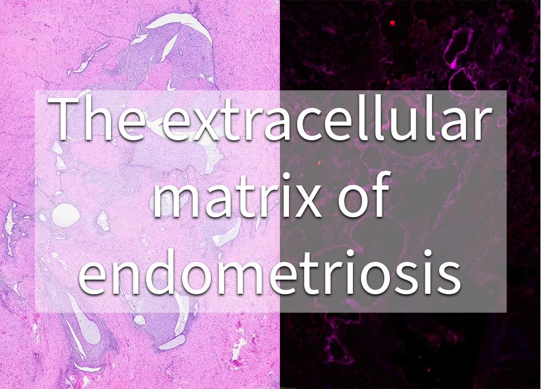 formepeorjectendometriosis