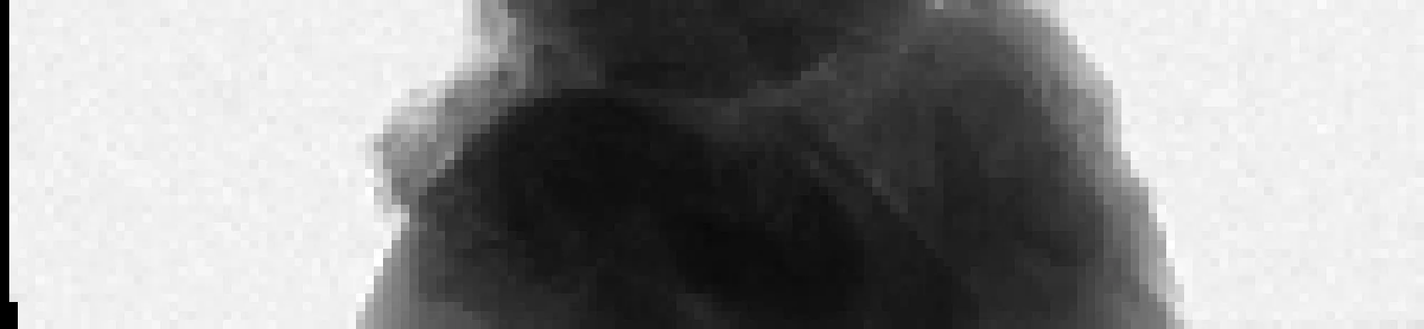 kidney stone: low resolution analog image (no interpolation)