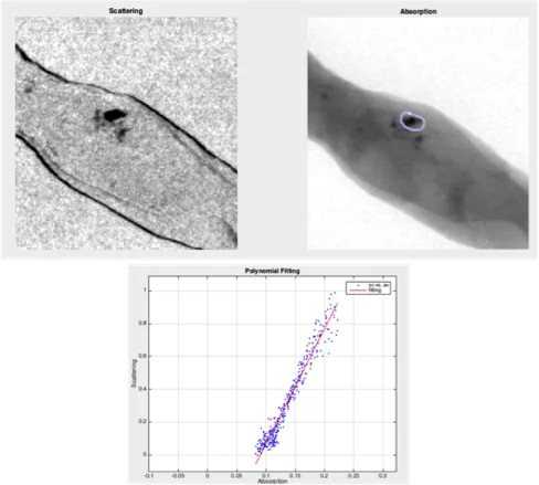 Absorption and scattering signals of microcalcification in breast biopsy tissue.