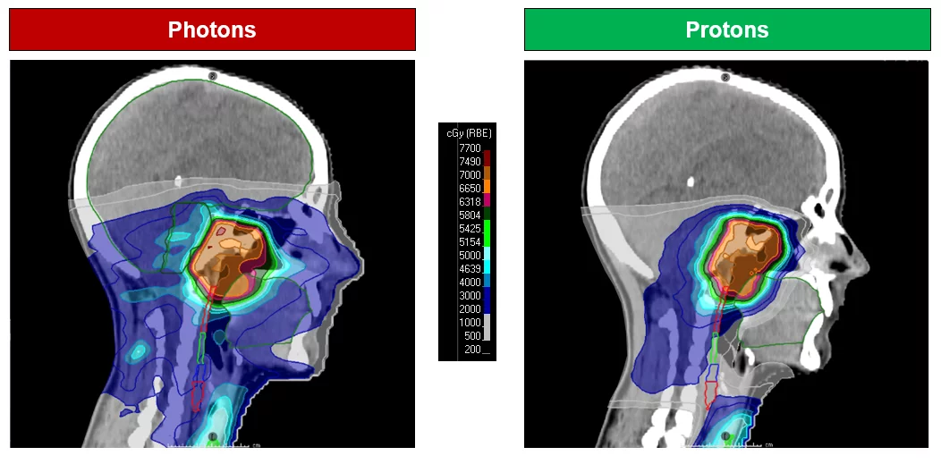 Comparaison de plans de traitement pour un patient atteint d’un carcinome de la cavité nasale. On constate que la dose de radiation dans la région buccale et de la voie de déglutition est nettement réduite dans le plan avec protons (à droite).