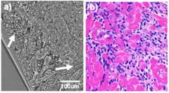 heart biopsies