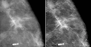 Der Vergleich von Röntgenaufnahmen von Brustgewebe mit einer konventionellen Mammografie sowie der neuen Mammografiemethode zeigt eine deutliche Verbesserung der Bildschärfe und damit der Sichtbarkeit der Ausläufer des Tumors (hell). (Details der oberen Bilder) Bild: Paul Scherrer Institut/Kantonsspital Baden