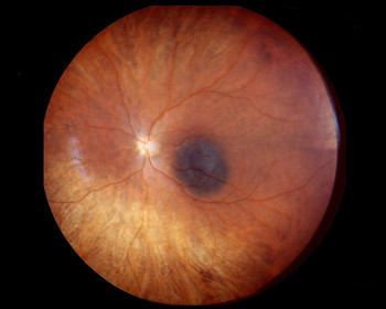 So sieht der Augenhintergrund eines Patienten mit Augenmelanom aus. Der schwarze Fleck in der Mitte ist der bösartige Tumor. Der kleine helle Kreis links daneben ist der sogenannte blinde Fleck. Hier treten der Sehnerv und Blutgefässe ins Auge. (Foto: Augenklinik Jules-Gonin in Lausanne)