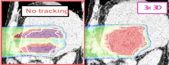 Calcul de dose en 4D avec tracking (à droite) et sans tracking (à gauche)