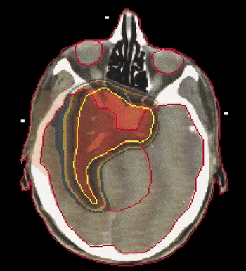 An example of a treatment plan delivered to a brain tumour showing the extent of the precision of the spot-scanning technique. The dose was tailored to the tumour extent (yellow) at all positions around the boundary line. The tissue outside of the tumour remained largely unirradiated.