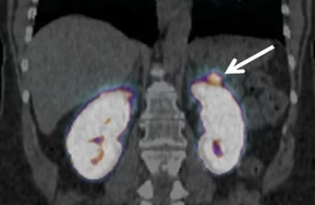 insulinom.jpg