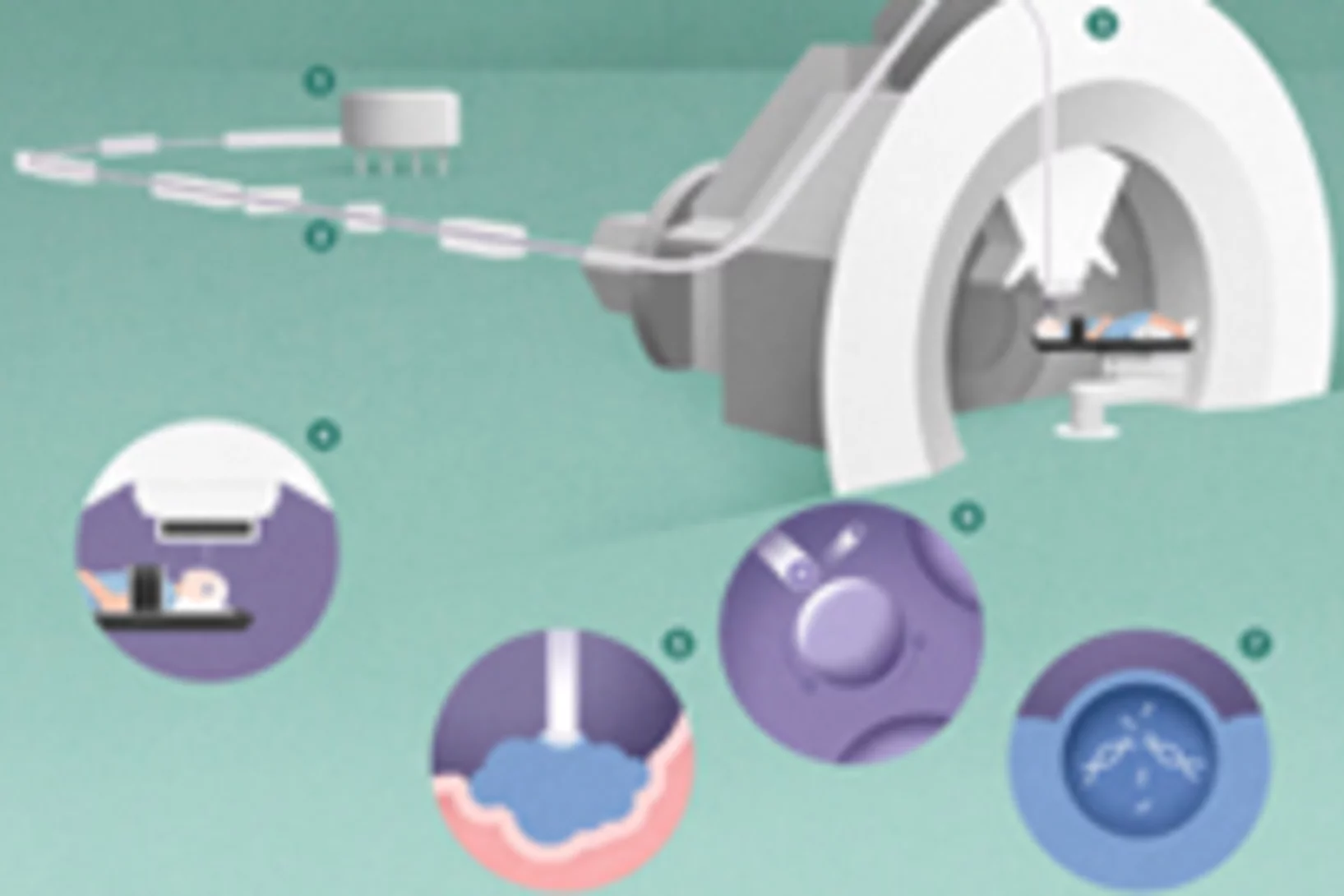 Teaser zur Infografik Feuer frei auf Tumore