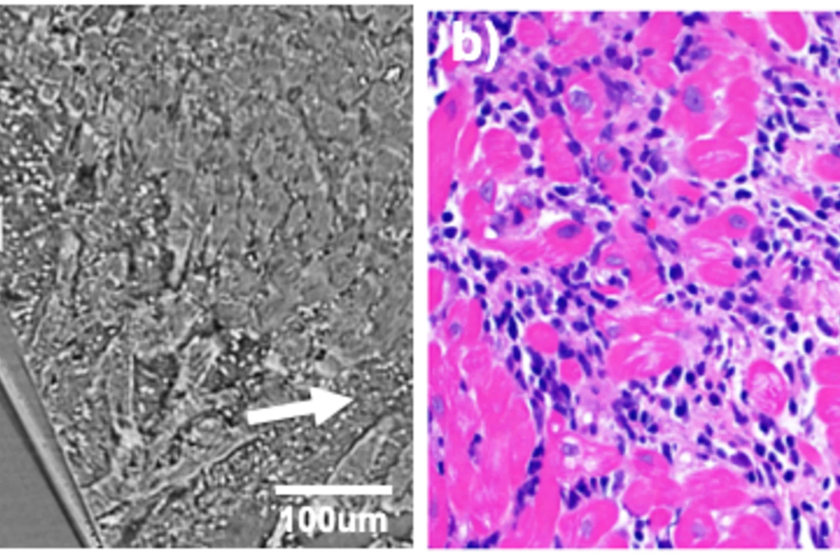 heart biopsies