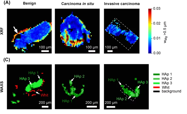 Whitlockite in mammary microcalcifications