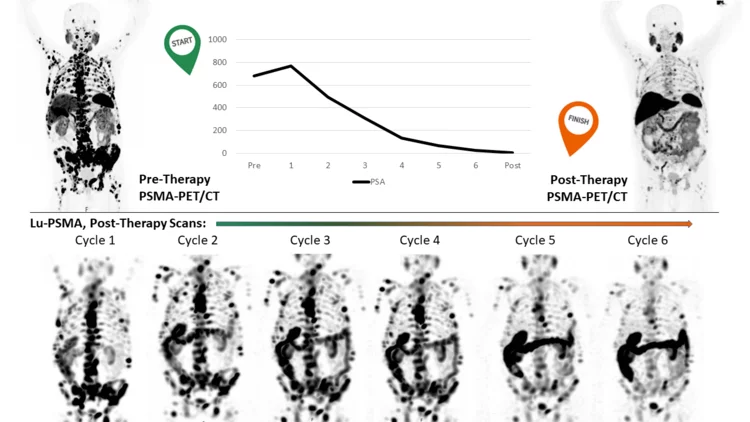 PSMA-PET